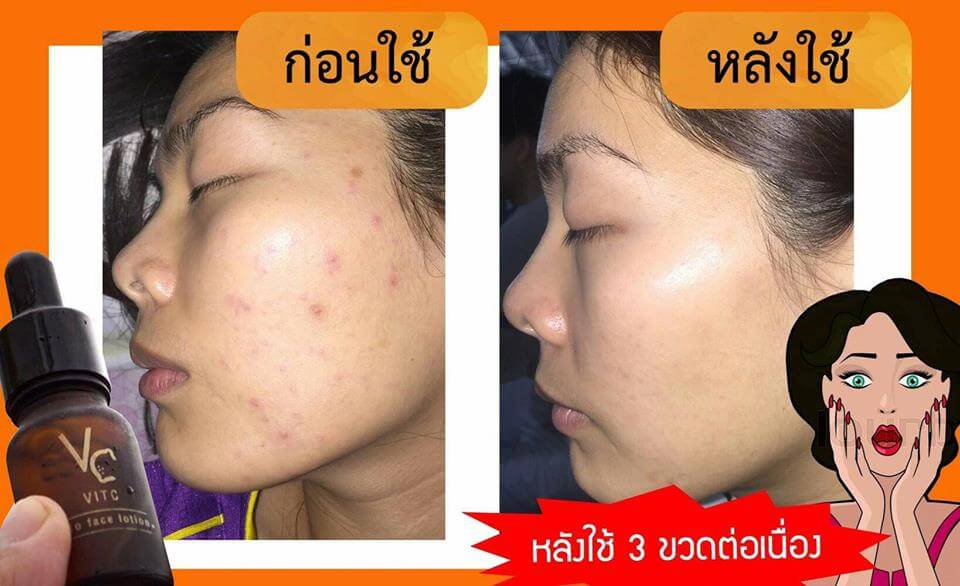 VitCBioFaceLotion ,VC ,VitC ,VitaminC ,น้ำใสๆแต่เด่นเรื่องบำรุง ,Serum VCเซรั่ม ,VCราคา,VCรีวิว,vit c bio face serum ของปลอม, vit c bio face serum วิธีใช้, vit c bio face serum ปลอม ,vit c bio face serum ดีไหม ,vit c bio face serum น้องฉัตร ,vit c bio face serum แพ้ ,vit c bio face serum first care serum 10ml ,vit c bio face serum ส่วนผสม ,vit c bio face serum - tity ,vit c bio face serum ใช้ดีไหม ,vit c bio face serum ,vit c bio face serum รีวิว ,vit c bio face serum ขายที่ไหน,vit c bio face serum ซื้อที่ไหน